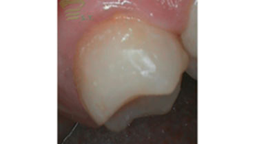upclose photo of tooth after dental procedure