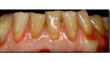 upclose photo of tooth before dental procedure